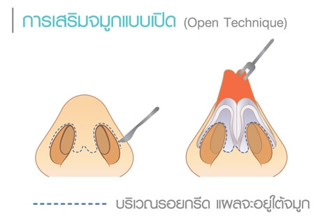 เสริมจมูก