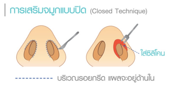 เสริมจมูก