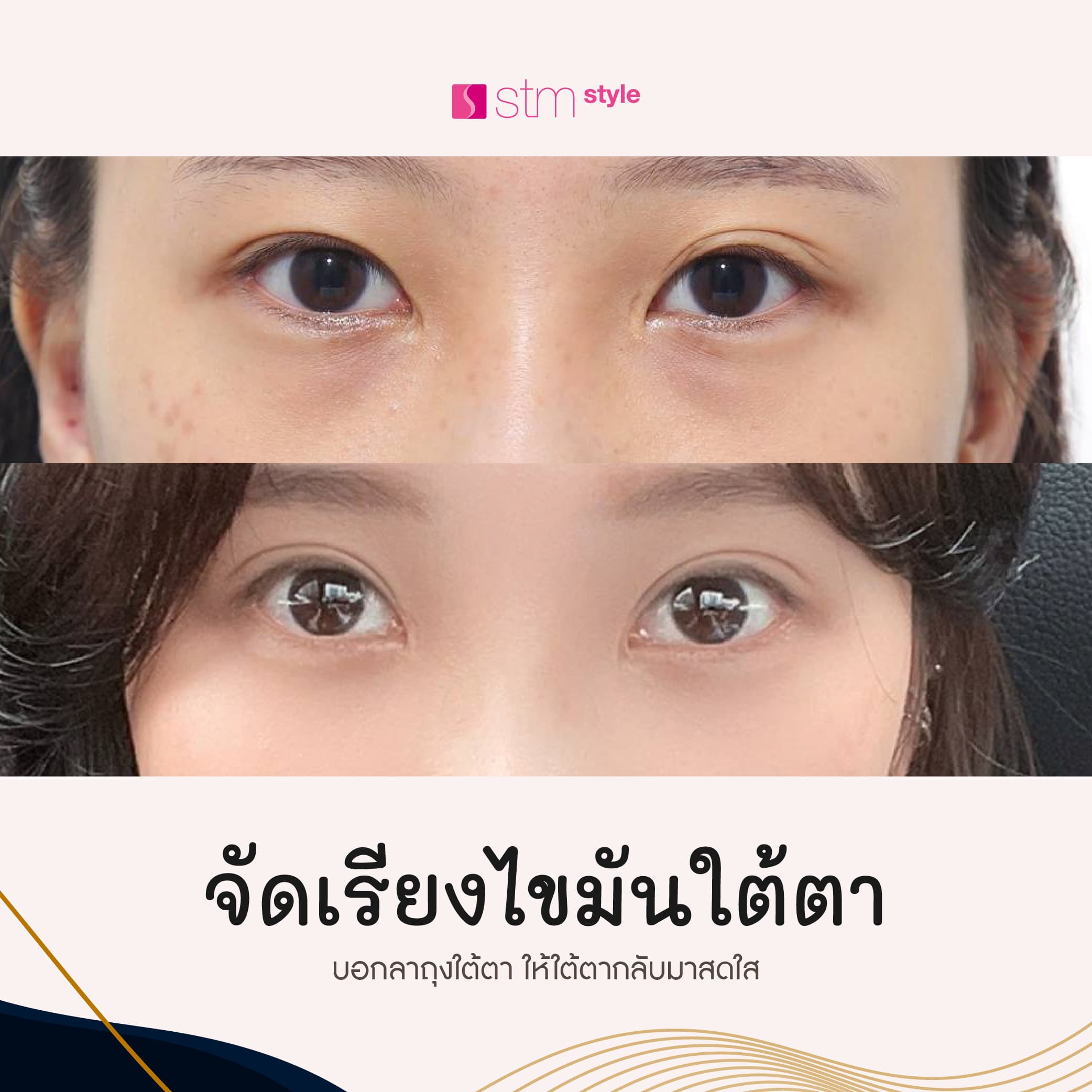 จัดเรียงไขมันใต้ตาโรงพยาบาลไอนีคINIQUE รีวิวจัดเรียงไขมันใต้ตาเกาหลี ศัลยกรรมตาเกาหลี กำจัดถุงใต้ตาเกาหลี STMstyle เอเจนซี่ศัลยกรรมเกาหลี