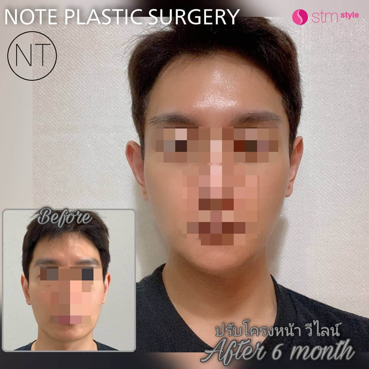 ปรับโครงหน้า V Line โรงพยาบาล NOTE รีวิวปรับโครงหน้าเกาหลี STMstyle เอเจนซี่ศัลยกรรมเกาหลี ปรับโครงหน้าผู้ชายเกาหลี โครงหน้า3จุด กรามคาง