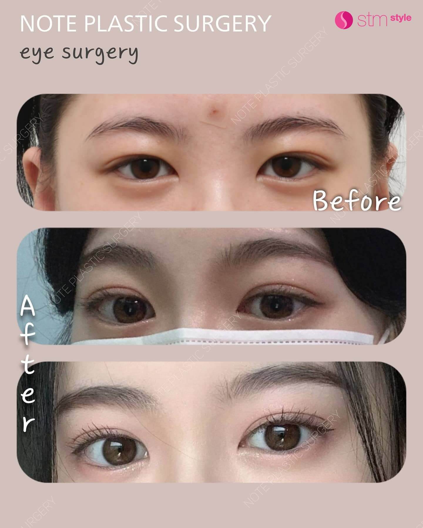 กรีดชั้นตาเปิดหางตาบนและล่าง รีวิวศัลยกรรมตาเกาหลี โรงพยาบาลศัลยกรรมเกาหลี STMstyle โรงพยาบาลบาลNOTE มัดกล้ามเนื้อตา ศัลยกรรมตาสองชั้น