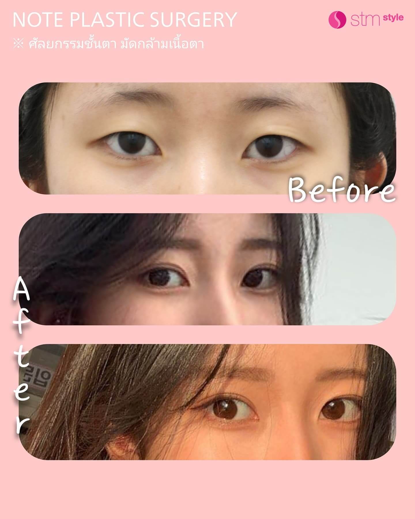 กรีดชั้นตาเปิดหางตาบนและล่าง รีวิวศัลยกรรมตาเกาหลี โรงพยาบาลศัลยกรรมเกาหลี STMstyle โรงพยาบาลบาลNOTE มัดกล้ามเนื้อตา ศัลยกรรมตาสองชั้น