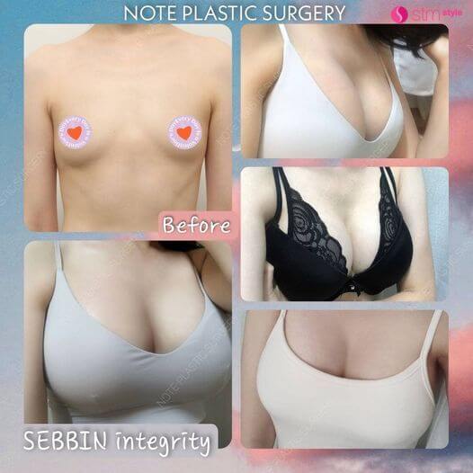 ศัลยกรรมหน้าอก SEBBIN โรงพยาบาล NOTE รีวิวเสริมหน้าอกเกาหลี SEBBIN รีวิวศัลยกรรมเกาหลี STMstyle เอเจนซี่ศัลยกรรมเกาหลี ซิลิโคลนSEBBIN