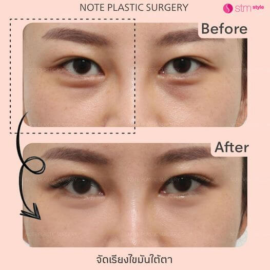 จัดเรียงไขมันใต้ตาโรงพยาบาล NOTE รีวิวจัดเรียงไขมันใต้ตาเกาหลี ศัลยกรรมถุงใต้ตาเกาหลี STMstyle เอเจนซี่ศัลยกรรมเกาหลี กำจัดถุงใต้ตาเกาหลี