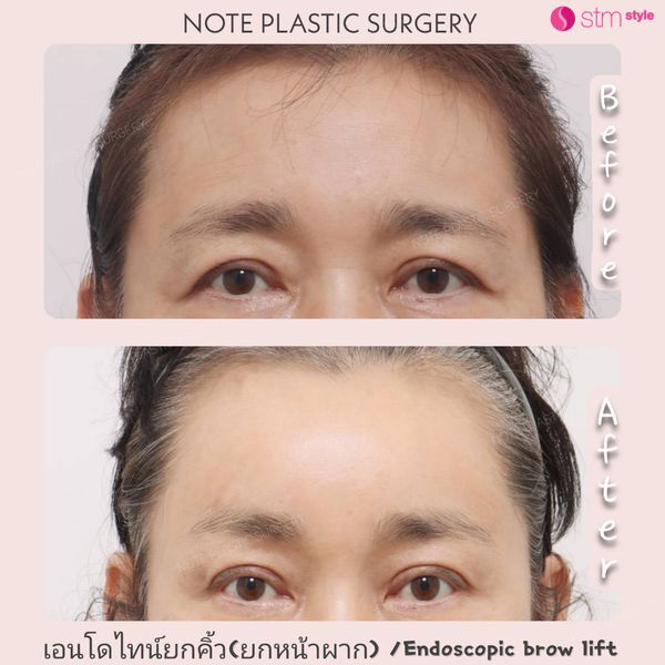 เอนโดไทน์ยกคิ้ว (หน้าผาก) | Endoscopic Brow Fit เอนโดไทน์หน้าผาก ยกกระชับหน้าผาก ยกคิ้ว รีวิวยกกระชับหน้าผาก โรงพยาบาลNOTE STMstyle