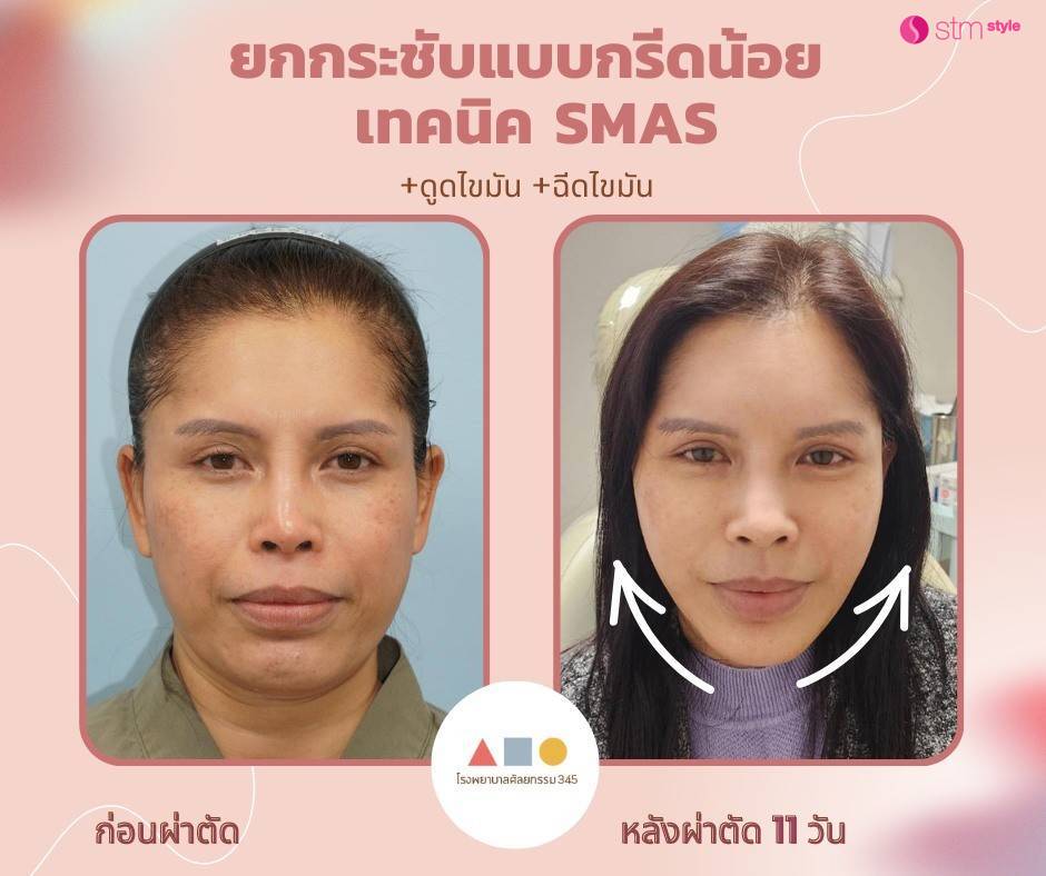 ยกกระชับแบบกรีดน้อย เทคนิก 345 โรงพยาบาล 345 ยกกระชับหน้า ลิฟติ้ง ยกกระชับหน้าเกาหลี ลิฟติ้งเกาหลี STMstyle เอเจนซี่ศัลยกรรมเกาหลี กรอบหน้า