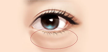 Lower eyelid cosmetic surgery.