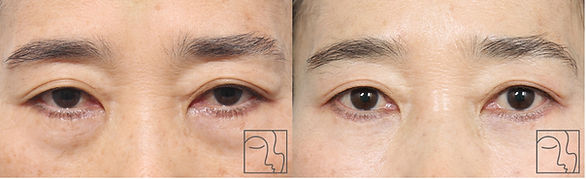 Lower eyelid cosmetic surgery.