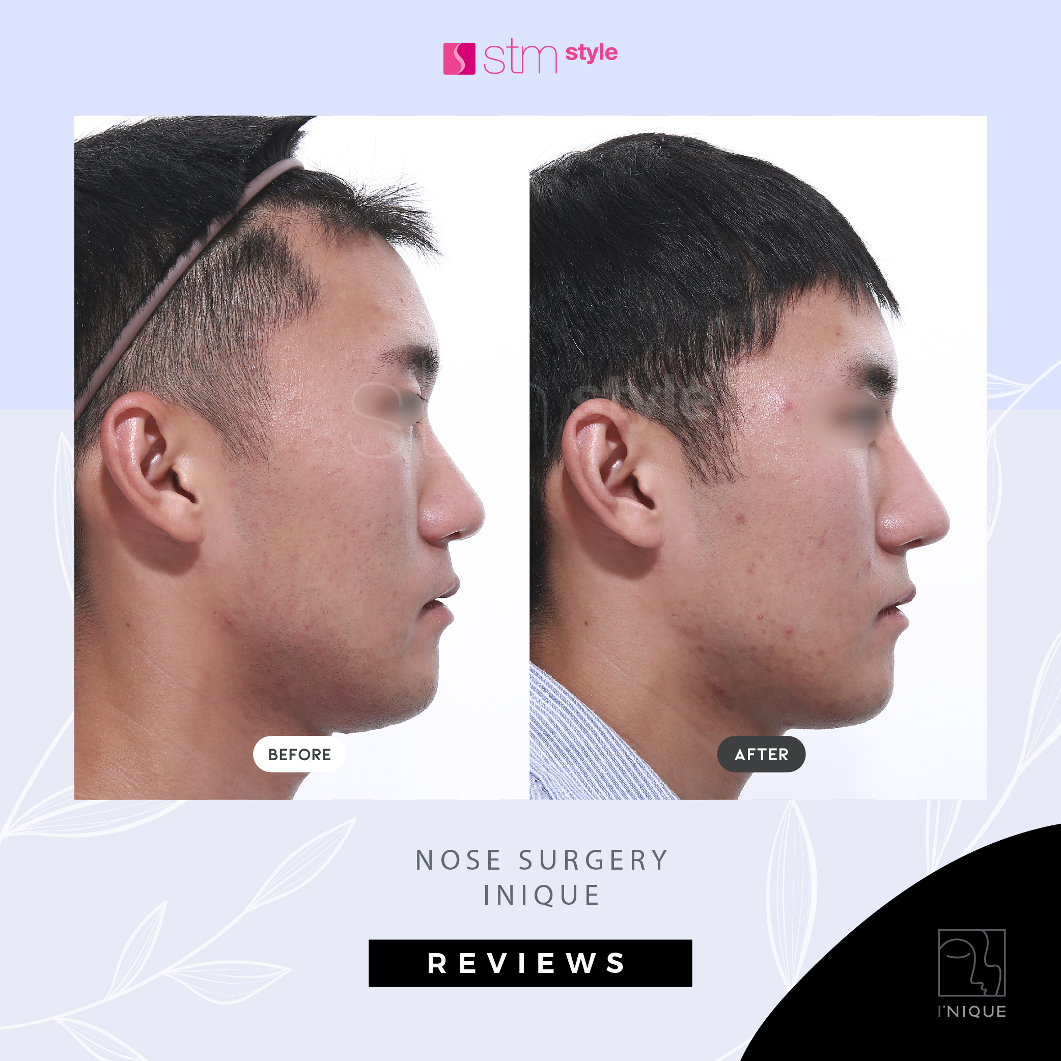 Nose surgery: Augmentation and refinement of the nasal tip. - STM Style