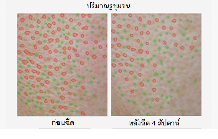 รีจูรัน (Rejuran)