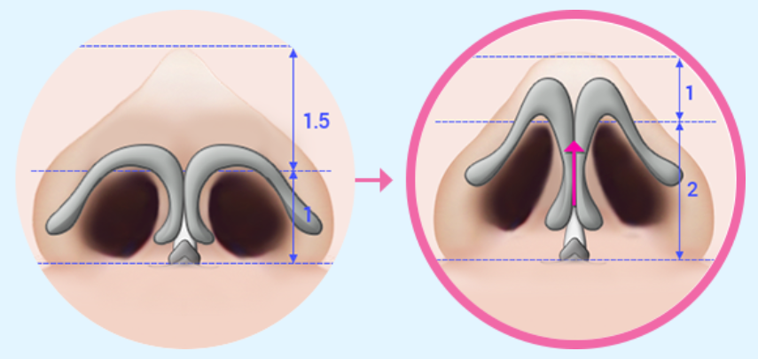 blepharoplasty