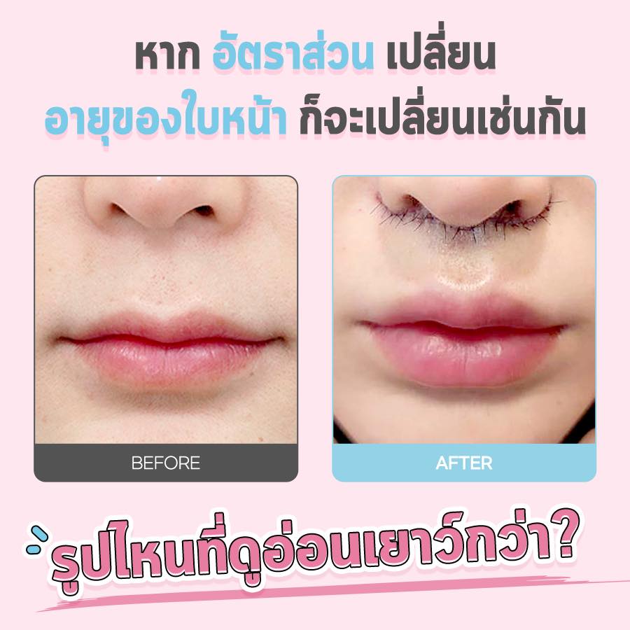 Reduce the size of the groove above the upper lip