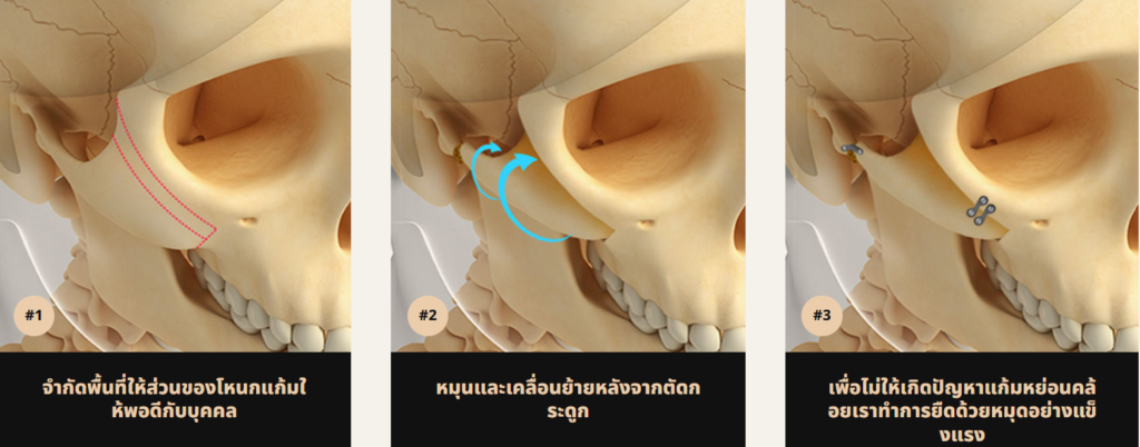 ลดโหนกแก้ม