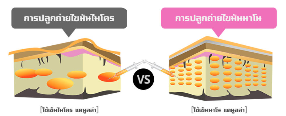 ฉีดไขมันหน้า