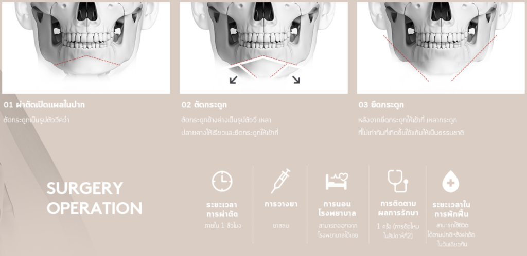 เสริมคาง