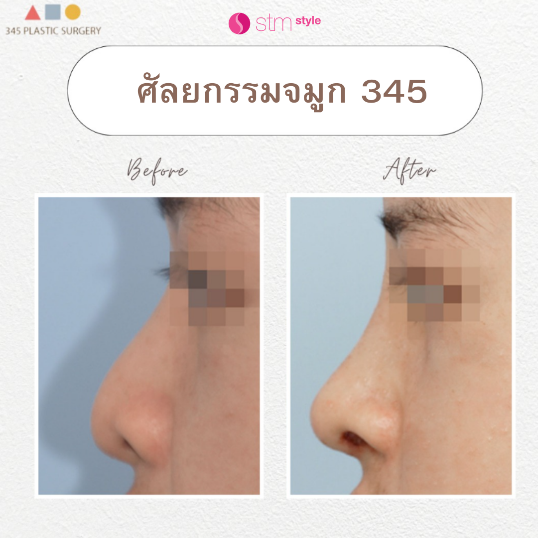 ศัลยกรรมจมูกผู้ชายโรงพยาบาล 345 รีวิวเสริมจมูกเกาหลี ศัลยกรรมจมูกผู้ชาย เสริมจมูกผู้ชาย STMstyle เอเจนซี่ศัลยกรรมเกาหลี รีวิวทำจมูกเกาหลี