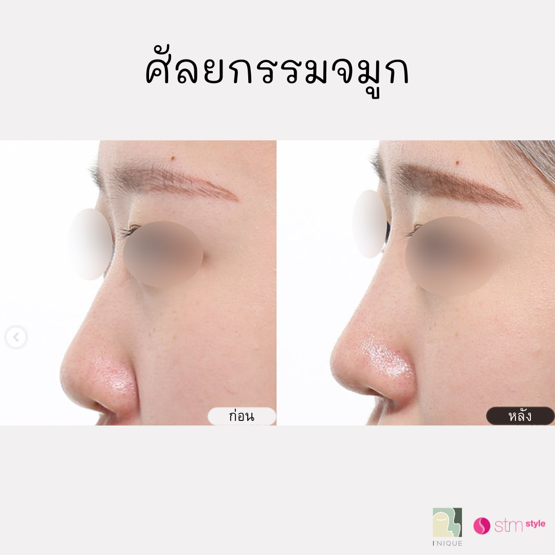 ศัลยกรรมจมูกโรงพยาบาลไอนีค INIQUE รีวิวเสริมจมูกเกาหลี ศัลยกรรมจมูกเกาหลี รีวิวศัลยกรรมเกาหลี STMstyle เอเจนซี่ศัลยกรรมเกาหลี ทำจมูกเกาหลี