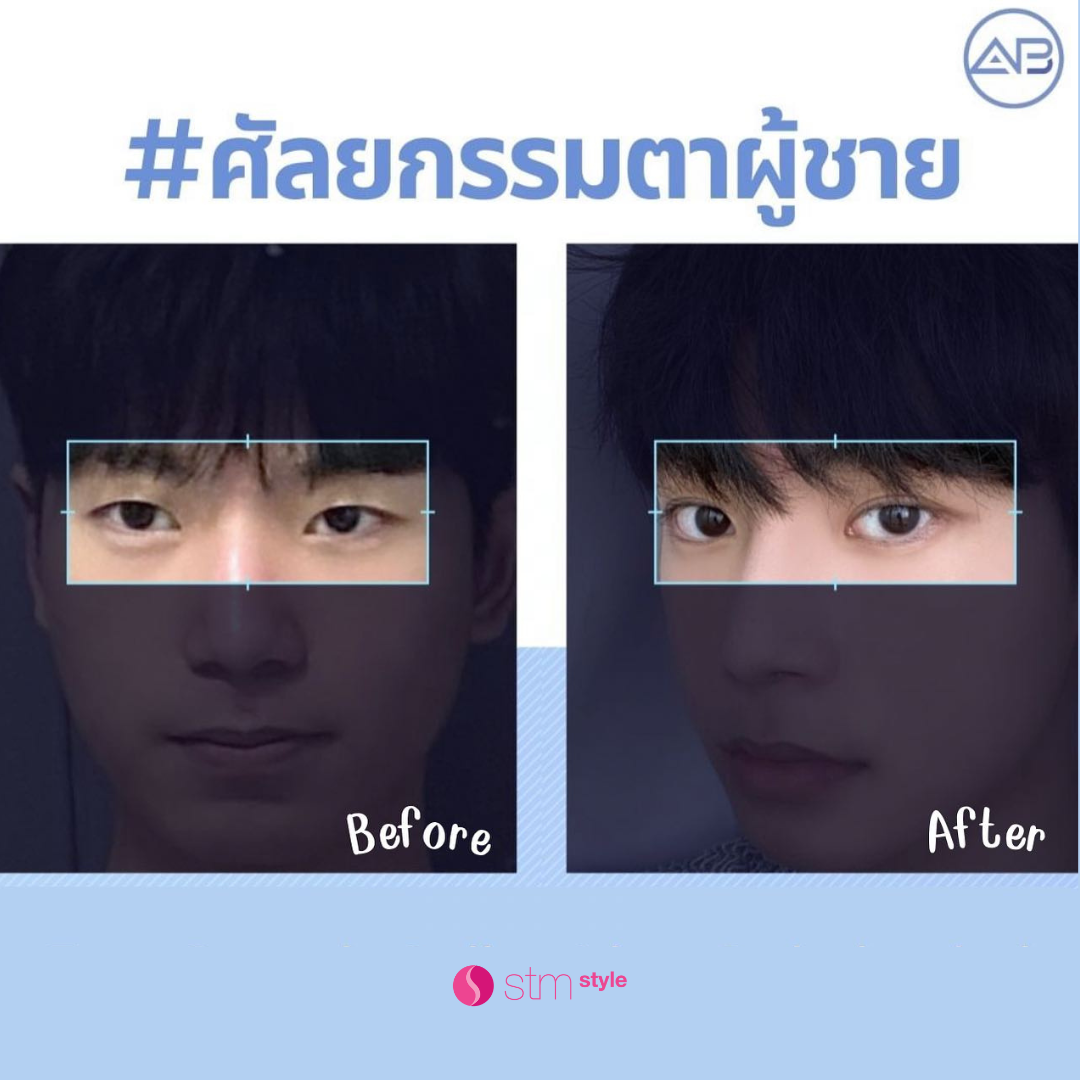 ศัลยกรรมตาโรงพยาบาล AB รีวิวศัลยกรรมตาเกาหลี รีวิวตาสองชั้นเกาหลี แก้ตาเกาหลี STMstyle เอเจนซี่ศัลยกรรมเกาหลี รีวิวแก้ตา ทำตาสองชั้นเกาหลี