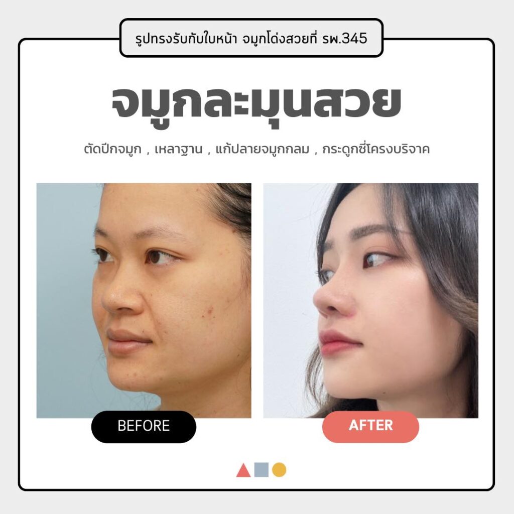 ศัลยกรรมจมูกโรงพยาบาล 345 รีวิวเสริมจมูกเกาหลี ศัลยกรรมจมูกเกาหลี รีวิวศัลยกรรมเกาหลี STMstyle เอเจนซี่ศัลยกรรมเกาหลี รีวิวทำจมูกเกาหลี