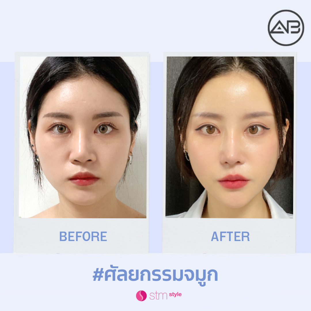 ศัลยกรรมจมูกโรงพยาบาล AB รีวิวเสริมจมูกเกาหลี ศัลยกรรมจมูกเกาหลี STMstyle เอเจนซี่ศัลยกรรมเกาหลี ทำจมูกเกาหลี เสริมจมูกโรงพยาบาล AB