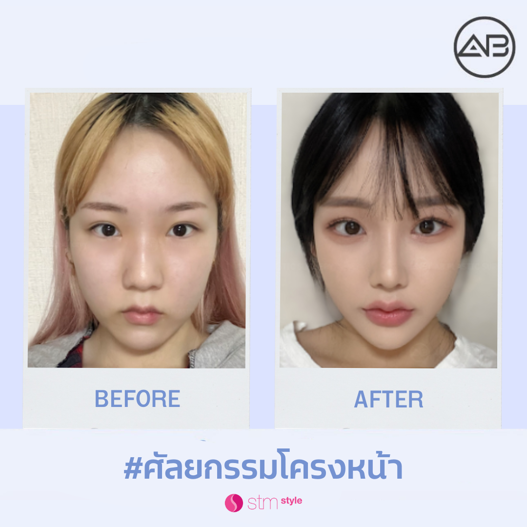 ศัลยกรรมโครงหน้าโรงพยาบาล AB รีวิวปรับโครงหน้าเกาหลี ศัลยกรรมโครงหน้าเกาหลี STMstyle เอเจนซี่ศัลยกรรม ปรับโครงหน้า3จุด โหนกแก้ม กราม คาง