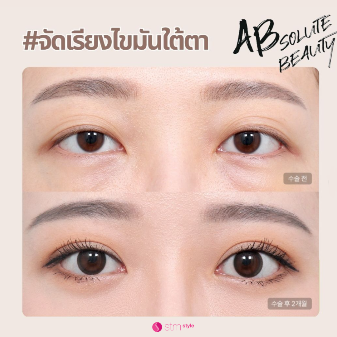 ศัลยกรรมตาโรงพยาบาล AB รีวิวศัลยกรรมตาเกาหลี รีวิวจัดเรียงไขมันใต้ตา ไขมันใต้ตา STMstyle เอเจนซี่ศัลยกรรมเกาหลี รีวิวแก้ตา ทำตาสองชั้นเกาหลี