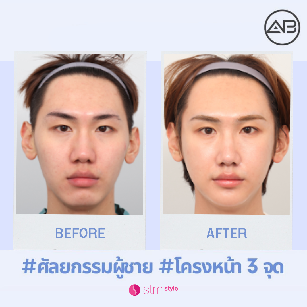 ศัลยกรรมปรับโครงหน้าโรงพยาบาล AB ปรับโครงหน้าผู้ชาย ศัลยกรรมโครงหน้าเกาหลี ปรับโครงหน้า3จุด โหนกแก้ม กราม คาง STMstyle เอเจนซี่ศัลยกรรมเกาหลี