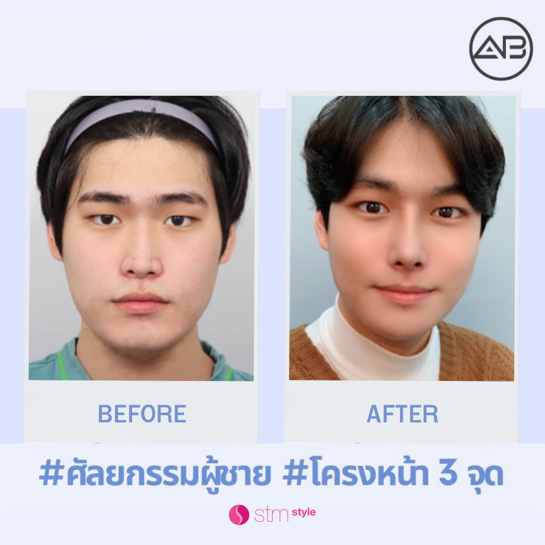 ศัลยกรรมโครงหน้าโรงพยาบาล AB รีวิวปรับโครงหน้าผู้ชาย ศัลยกรรมโครงหน้าเกาหลี รีวิวศัลยกรรมโครงหน้าผู้ชาย STMstyle เอเจนซี่ศัลยกรรมเกาหลี