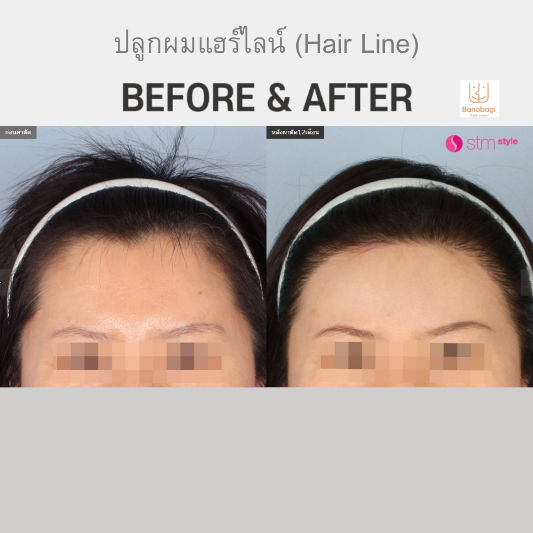 ปลูกผมแฮร์ไลน์(Hair Line) บาโนบากิ BANOBAGI ปลูกผมเกาหลี แนวแฮไลน์ ไรผม ลูกผม STMstyle เอเจนซี่ศัลยกรรมเกาหลี รีวิวปลูกผม รีวิวปลูกผมผู้หญิง