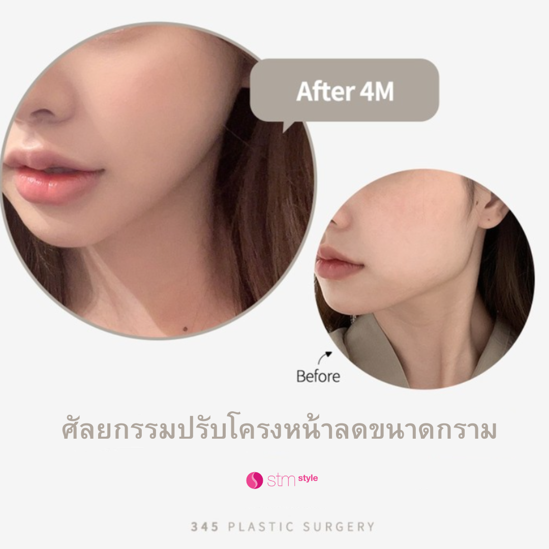 ศัลยกรรมโครงหน้าโรงพยาบาล 345 รีวิวปรับโครงหน้าเกาหลี ศัลยกรรมโครงหน้าเกาหลี STMstyle เอเจนซี่ศัลยกรรมเกาหลี ปรับโครงหน้า3จุดโหนกแก้มกรามคาง